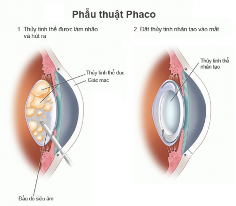 Chữa cận thị hoàn toàn bằng phẫu thuật thay thủy tinh thể Phaco