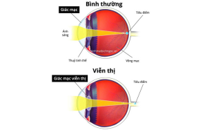 Mắt người viễn thị và mắt người chính thị